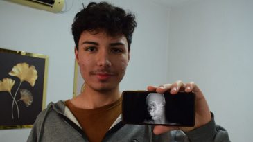 1,5 Yıldır Başındaki Mermiyle Yaşıyor
