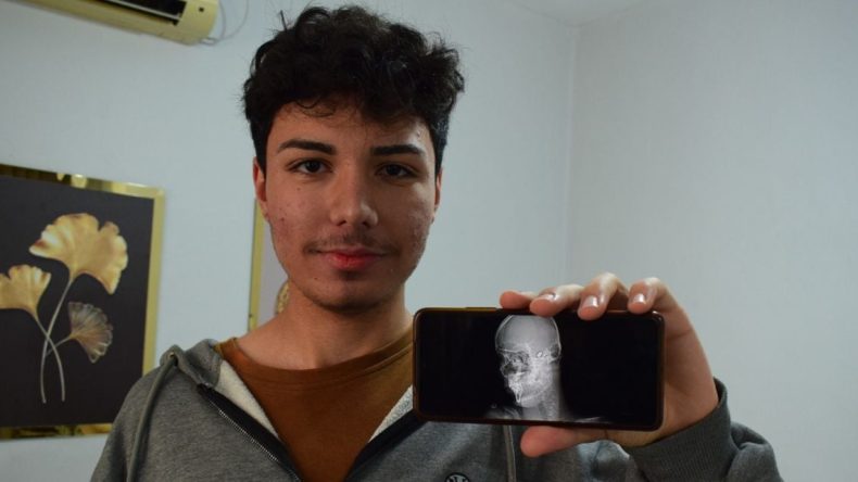 1,5 Yıldır Başındaki Mermiyle Yaşıyor