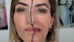 Yüzünün Sadece Bir Tarafına Botoks Uyguladı, Fark Ortaya Çıktı