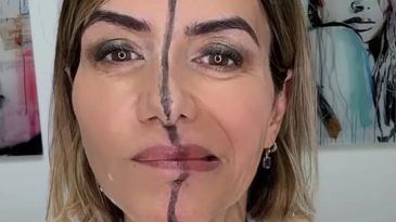 Yüzünün Sadece Bir Tarafına Botoks Uyguladı, Fark Ortaya Çıktı