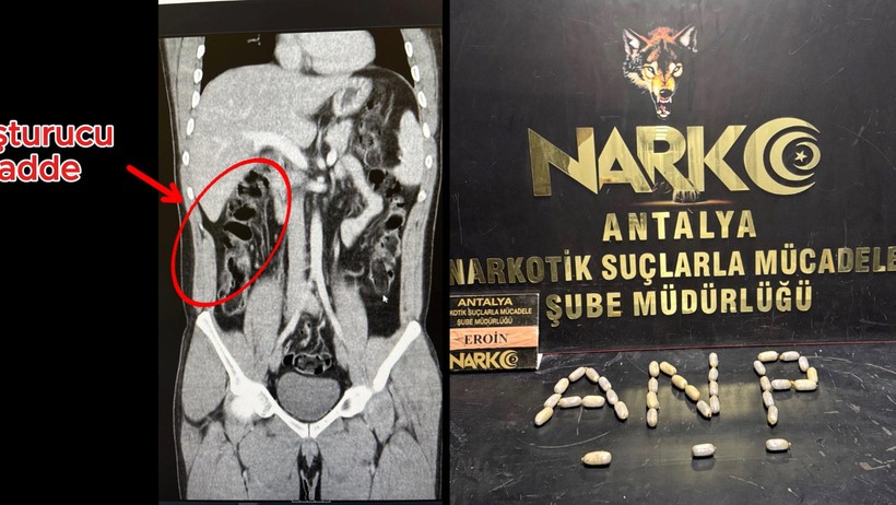 Uyuşturucu Kapsül Çıkarma İşlemi