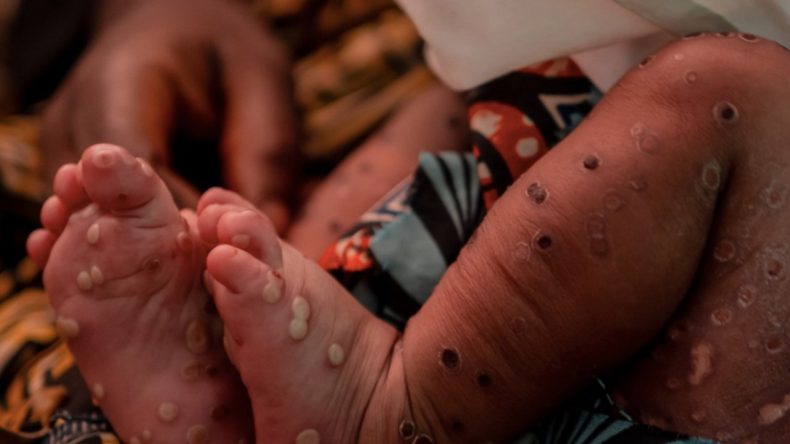 Mpox Vakalarında Artış Yaşanıyor
