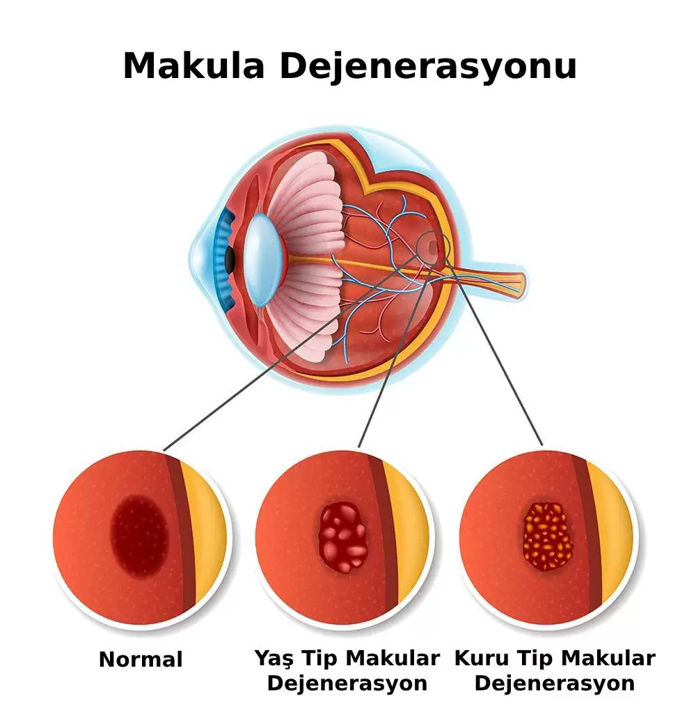 Sarı Nokta Hastalığı