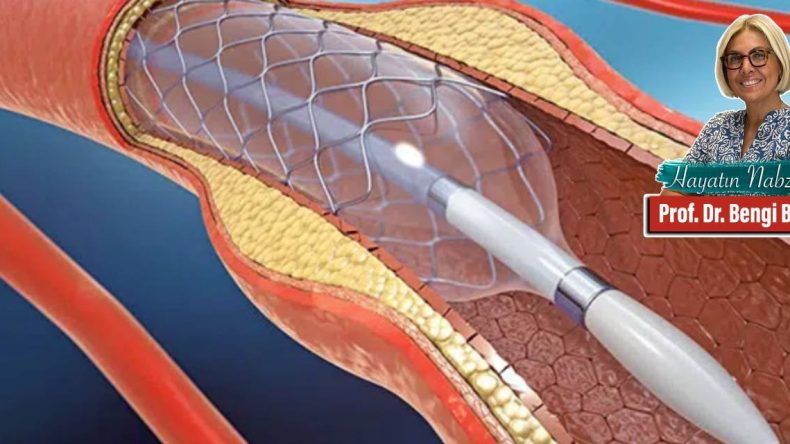 Stent Uygulamaları