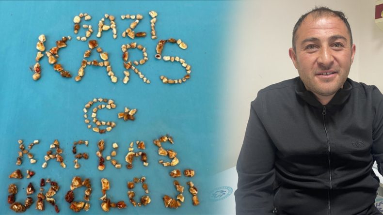 Taş Ocağı Mübarek! Böbreğinden Çıkan Taşları Eve Götürdü