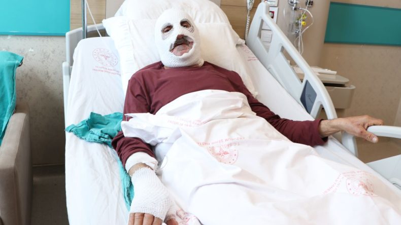 Tüpü Çakmakla Kontrol Etti, Hastanelik Oldu